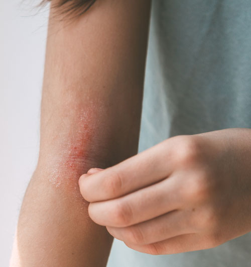 hauterkrankung_over hauterkrankung_over