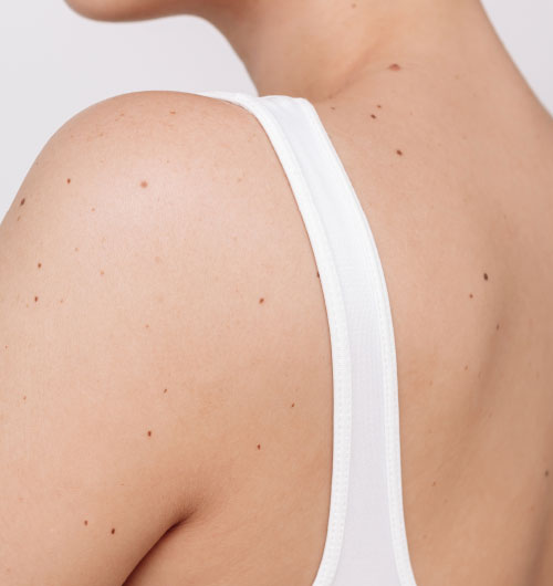 hautkrebs_over hautkrebs_over